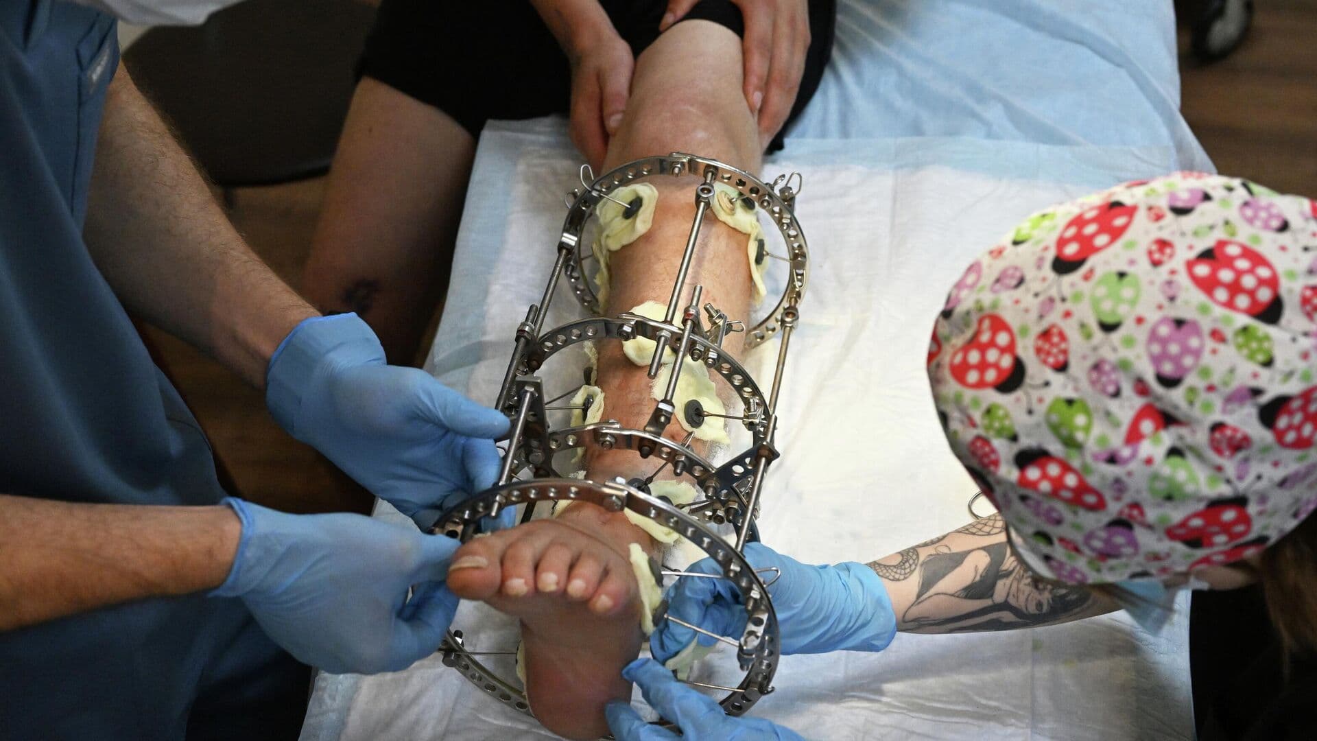 Врач рассказал об уникальных операциях, которые делают бойцам СВО