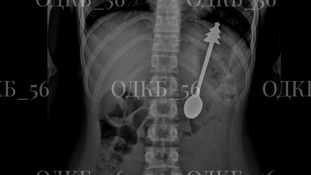 В Оренбургской области ребенок случайно проглотил 14-сантиметровую ложку