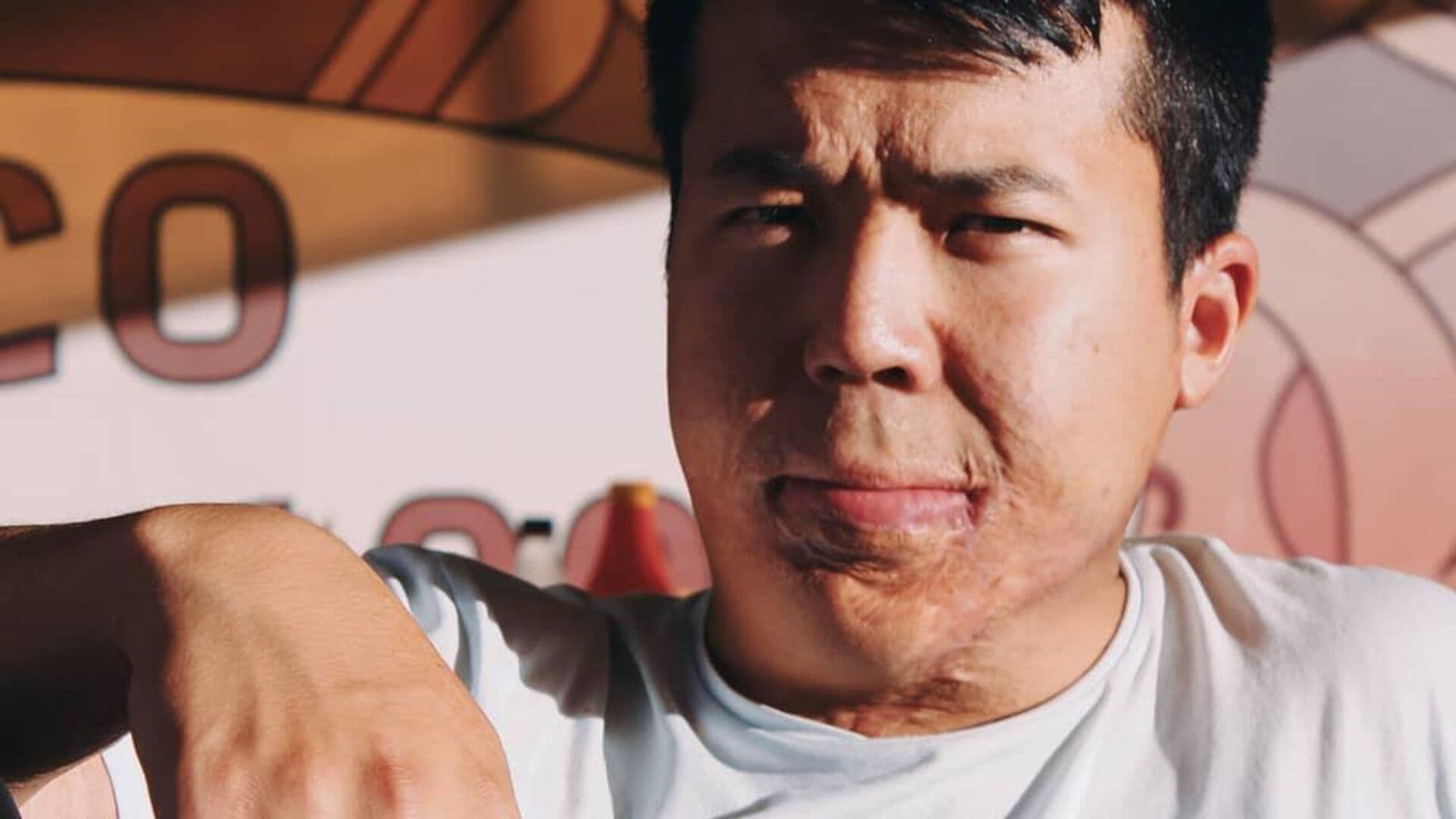 "Шея прилипла к подбородку": откровения выживших после сильнейших ожогов