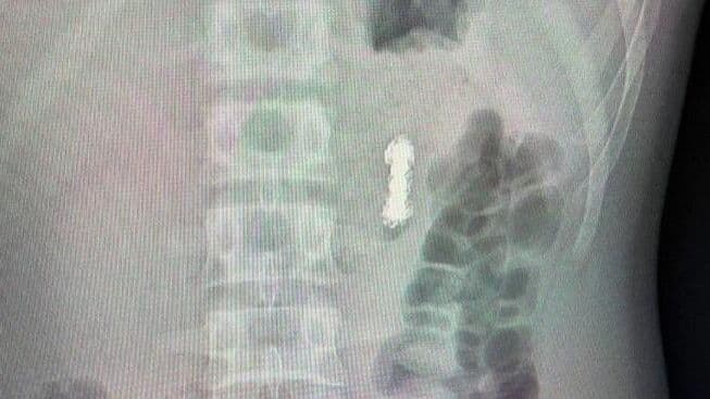 Подмосковные врачи спасли мальчика с 11 магнитами в желудке