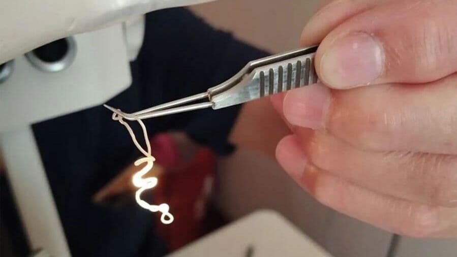 В Чувашии из глаза мужчины извлекли 20-сантиметрового червя