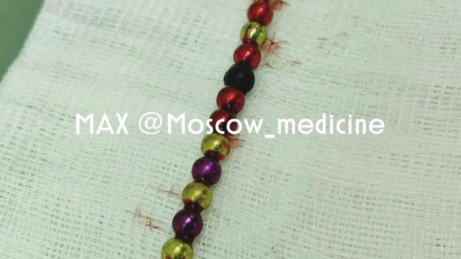 В Москве врачи спасли ребенка, проглотившего 19 магнитов