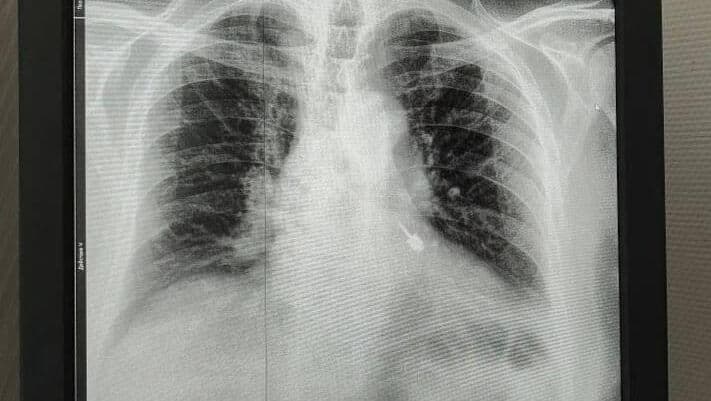 В Подмосковье спасли пациента, проглотившего бур во время лечения зубов