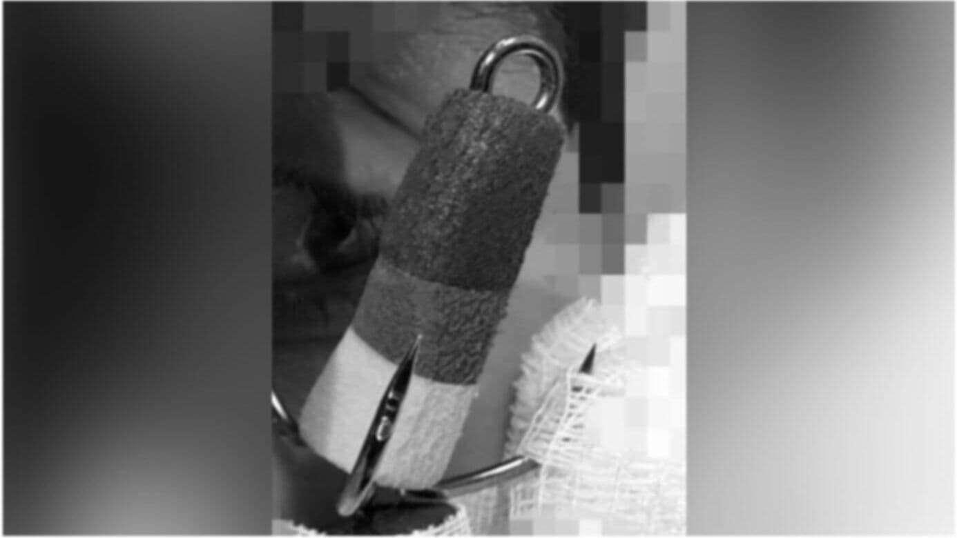 Подмосковные врачи спасли мальчика с застрявшим в глазу рыболовным крючком